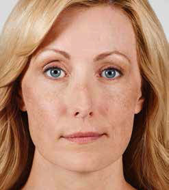 Juvederm Before & After Image