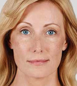 Juvederm Before & After Image