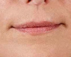 Juvederm Before & After Image