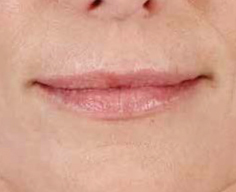 Juvederm Before & After Image