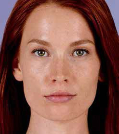 Juvederm Before & After Image