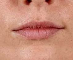 Juvederm Before & After Image