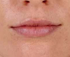 Juvederm Before & After Image