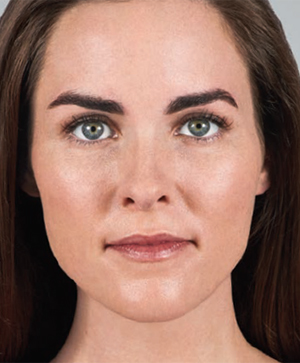 Juvederm Before & After Image