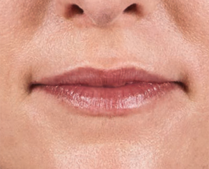 Juvederm Before & After Image