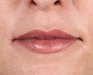 Juvederm Before & After Image