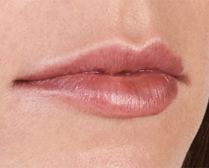 Juvederm Before & After Image