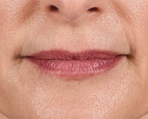 Juvederm Before & After Image