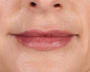 Juvederm Before & After Image