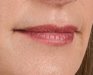 Juvederm Before & After Image