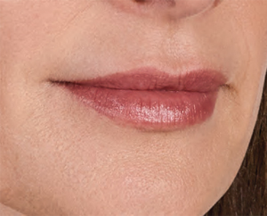 Juvederm Before & After Image