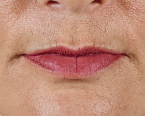 Juvederm Before & After Image