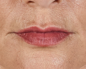 Juvederm Before & After Image