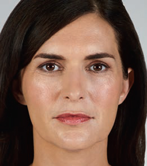 Juvederm Before & After Image