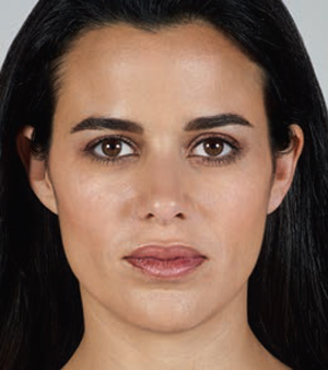 Juvederm Before & After Image