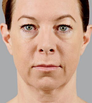 Juvederm Before & After Image