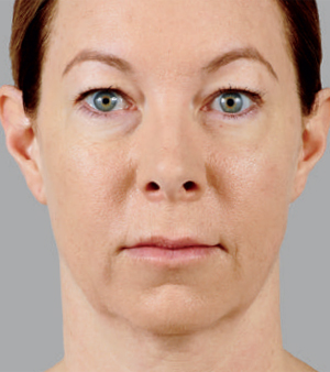 Juvederm Before & After Image