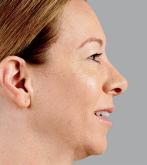 Juvederm Before & After Image