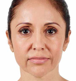 Juvederm Before & After Image