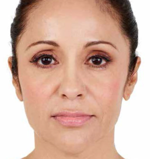 Juvederm Before & After Image