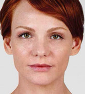 Juvederm Before & After Image