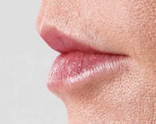 Juvederm Before & After Image