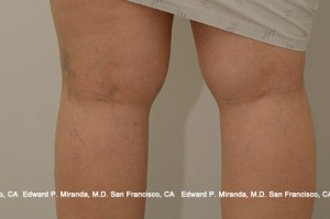 Sclerotherapy Before & After Image