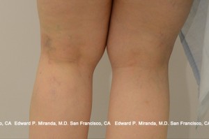 Sclerotherapy Before & After Image