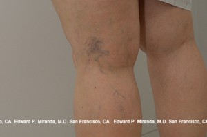 Sclerotherapy Before & After Image