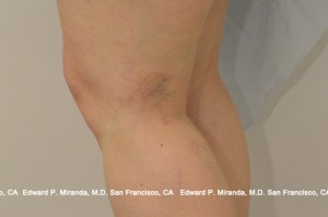 Sclerotherapy Before & After Image