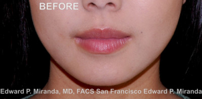 Jaw Reduction Before & After Image
