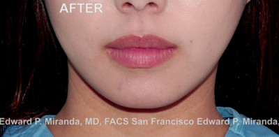Jaw Reduction Before & After Image