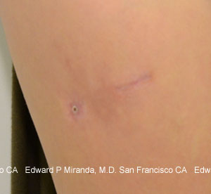Scar Revision Before & After Image